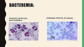 BACTEREMIA:
STAPHYLOCOCCAL
BACTEREMIA
YERSINIA PESTIS (PLAGUE)
 