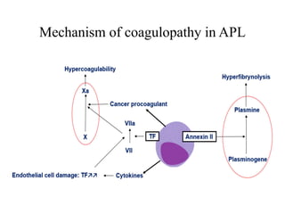 Mechanism of coagulopathy in APL
 