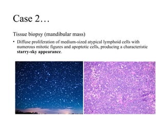 Case 2…
Tissue biopsy (mandibular mass)
• Diffuse proliferation of medium-sized atypical lymphoid cells with
numerous mitotic figures and apoptotic cells, producing a characteristic
starry-sky appearance.
 