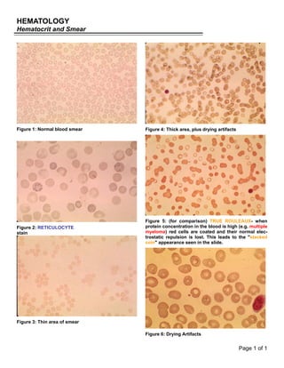 HEMATOLOGY
Hematocrit and Smear
Page 1 of 1
Figure 1: Normal blood smear
Figure 2: RETICULOCYTE
stain
Figure 3: Thin area of smear
Figure 4: Thick area, plus drying artifacts
Figure 5: (for comparison) TRUE ROULEAUX- when
protein concentration in the blood is high (e.g. multiple
myeloma) red cells are coated and their normal elec-
trostatic repulsion is lost. This leads to the "stacked
coin" appearance seen in the slide.
Figure 6: Drying Artifacts
 