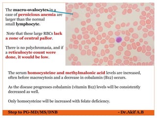 Step to PG-MD/MS/DNB - Dr.Akif A.B
The macro-ovalocytes in a
case of pernicious anemia are
larger than the normal
small lymphocyte.
Note that these large RBCs lack
a zone of central pallor.
There is no polychromasia, and if
a reticulocyte count were
done, it would be low.
The serum homocysteine and methylmalonic acid levels are increased,
often before macrocytosis and a decrease in cobalamin (B12) occurs.
As the disease progresses cobalamin (vitamin B12) levels will be consistently
decreased as well.
Only homocysteine will be increased with folate deficiency.
 