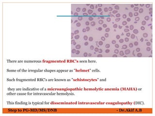 Step to PG-MD/MS/DNB - Dr.Akif A.B
There are numerous fragmented RBC's seen here.
Some of the irregular shapes appear as "helmet" cells.
Such fragmented RBC's are known as "schistocytes" and
they are indicative of a microangiopathic hemolytic anemia (MAHA) or
other cause for intravascular hemolysis.
This finding is typical for disseminated intravascular coagulopathy (DIC).
 
