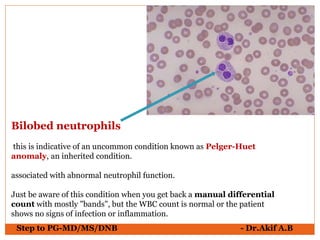Step to PG-MD/MS/DNB - Dr.Akif A.B
Bilobed neutrophils
this is indicative of an uncommon condition known as Pelger-Huet
anomaly, an inherited condition.
associated with abnormal neutrophil function.
Just be aware of this condition when you get back a manual differential
count with mostly "bands", but the WBC count is normal or the patient
shows no signs of infection or inflammation.
 