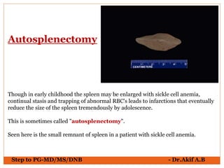 Step to PG-MD/MS/DNB - Dr.Akif A.B
Though in early childhood the spleen may be enlarged with sickle cell anemia,
continual stasis and trapping of abnormal RBC's leads to infarctions that eventually
reduce the size of the spleen tremendously by adolescence.
This is sometimes called "autosplenectomy".
Seen here is the small remnant of spleen in a patient with sickle cell anemia.
Autosplenectomy
 
