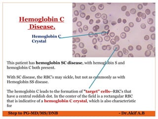 Step to PG-MD/MS/DNB - Dr.Akif A.B
This patient has hemoglobin SC disease, with hemoglobin S and
hemoglobin C both present.
With SC disease, the RBC's may sickle, but not as commonly as with
Hemoglobin SS disease.
The hemoglobin C leads to the formation of "target" cells--RBC's that
have a central reddish dot. In the center of the field is a rectangular RBC
that is indicative of a hemoglobin C crystal, which is also characteristic
for
Hemoglobin C
Disease.
Hemoglobin C
Crystal
 