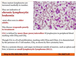 These mature lymphocytes are
increased markedly in number.
They are indicative of
chronic lymphocytic
leukemia
most often seen in older
adults.
This disease responds poorly
to treatment
CLL is defined by more than 5000/microliter B lymphocytes in peripheral blood
marking with CD23 and CD5.
Though CLL is a B cell proliferation, marking with CD19 and CD20, it is characterized
by the presence of a T cell marker, CD5, as shown by flow cytometry here.
This is a systemic disease, and organ involement outside of marrow, such as spleen and
liver, is known as small lymphocytic lymphoma (SLL).
Step to PG-MD/MS/DNB - Dr.Akif A.B
 