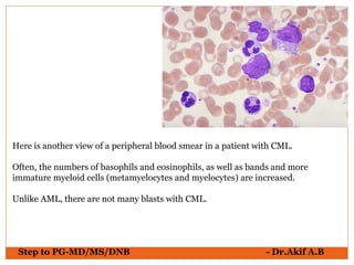 Here is another view of a peripheral blood smear in a patient with CML.
Often, the numbers of basophils and eosinophils, as well as bands and more
immature myeloid cells (metamyelocytes and myelocytes) are increased.
Unlike AML, there are not many blasts with CML.
Step to PG-MD/MS/DNB - Dr.Akif A.B
 