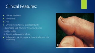 Clinical Features:
 Features of Anemia
 Koilonychia
 Pica
 Chronic iron deficiency is associated with:
i. Esophageal web (Plummer-Vinson syndrome)
ii. Achlorhydria
iii. Glossitis and Angular cheilosis
 Inflammation of the tongue and corner of the mouth,
respectively
 