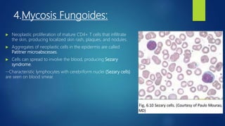 4.Mycosis Fungoides:
 Neoplastic proliferation of mature CD4+ T cells that infiltrate
the skin, producing localized skin rash, plaques, and nodules.
 Aggregates of neoplastic cells in the epidermis are called
Patitrier microabscesses.
 Cells can spread to involve the blood, producing Sezary
syndrome.
--Characteristic lymphocytes with cerebriform nuclei (Sezary cells)
are seen on blood smear.
 