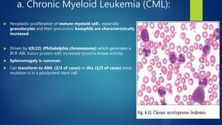 a. Chronic Myeloid Leukemia (CML):
 Neoplastic proliferation of mature myeloid cells, especially
granulocytes and their precursors; basophils are characteristically
increased.
 Driven by t(9;22) (Philadelphia chromosome) which generates a
BCR-ABL fusion protein with increased tyrosine kinase activity.
 Splenomegaly is common.
 Can transform to AML (2/3 of cases) or ALL (1/3 of cases) since
mutation is in a pluripotent stem cell.
 