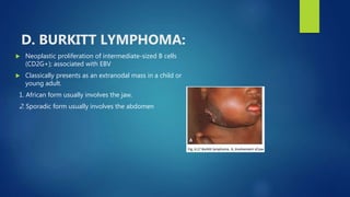 D. BURKITT LYMPHOMA:
 Neoplastic proliferation of intermediate-sized B cells
(CD2G+); associated with EBV
 Classically presents as an extranodal mass in a child or
young adult.
1. African form usually involves the jaw.
2. Sporadic form usually involves the abdomen
 