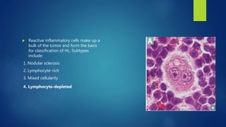  Reactive inflammatory cells make up a
bulk of the tumor and form the basis
for classification of HL, Subtypes
include:
1. Nodular sclerosis
2. Lymphocyte-rich
3. Mixed cellularity
4. Lymphocyte-depleted
 