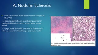 A. Nodular Sclerosis:
 Nodular sclerosis is the most common subtype of
HL (70%)
1. Classic presentation is an enlarging cervical or
mediastinal lymph node in a young adult, usually
female.
2. Lymph node is divided by bands of sclerosis; RS
cells are present in lake-like spaces (lacunar cells)
 