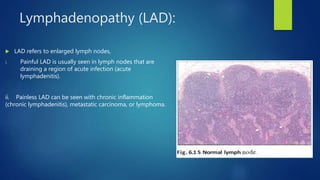 Lymphadenopathy (LAD):
 LAD refers to enlarged lymph nodes,
i. Painful LAD is usually seen in lymph nodes that are
draining a region of acute infection (acute
lymphadenitis).
ii. Painless LAD can be seen with chronic inflammation
(chronic lymphadenitis), metastatic carcinoma, or lymphoma.
 