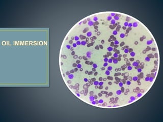 hematology equas case of acute leukemia.pptx