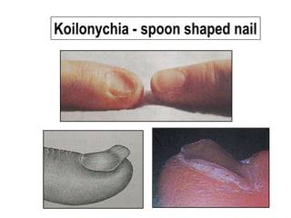 Koilonychia - spoon shaped nail
 