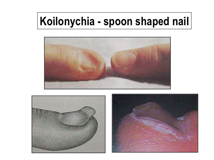 pica syndrome iron deficiency pica syndrome iron deficiency