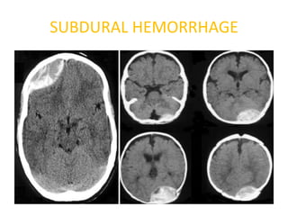 SUBDURAL HEMORRHAGE
 