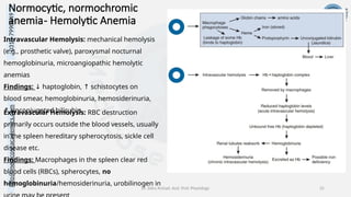 info@medicoseacademics.com
0310-7990649
Dr. Sidra Arshad, Asst. Prof. Physiology 25
Normocytic, normochromic
anemia- Hemolytic Anemia
Intravascular Hemolysis: mechanical hemolysis
(e.g., prosthetic valve), paroxysmal nocturnal
hemoglobinuria, microangiopathic hemolytic
anemias
Findings: haptoglobin, schistocytes on
↓ ↑
blood smear, hemoglobinuria, hemosiderinuria,
unconjugated bilirubin
↑
Extravascular Hemolysis: RBC destruction
primarily occurs outside the blood vessels, usually
in the spleen hereditary spherocytosis, sickle cell
disease etc.
Findings: Macrophages in the spleen clear red
blood cells (RBCs), spherocytes, no
hemoglobinuria/hemosiderinuria, urobilinogen in
 