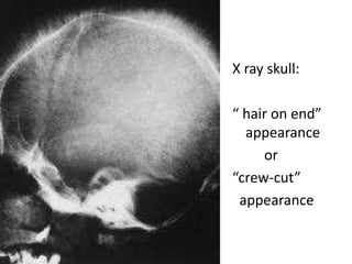 X ray skull:

“ hair on end”
  appearance
     or
“crew-cut”
 appearance
 