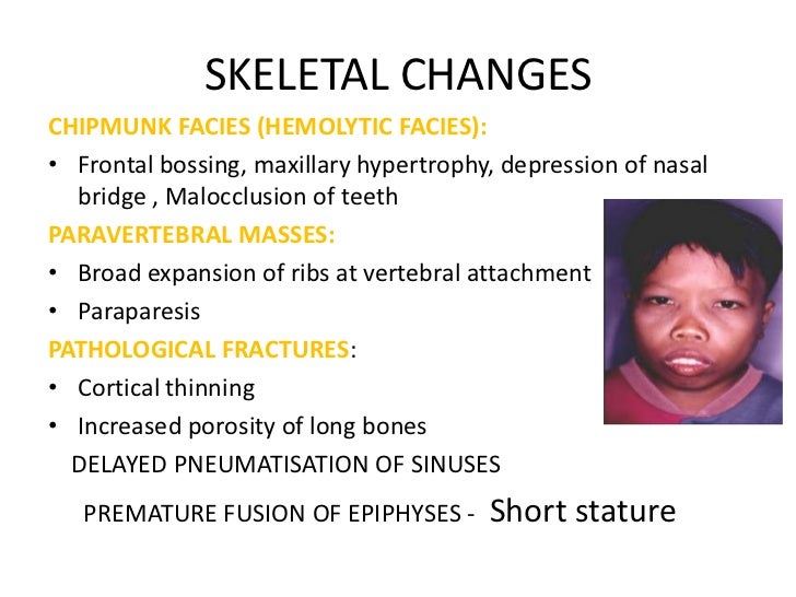 Beta Thalassemia Major Face