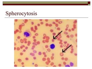 Hematology (1) The blood and bone marrow, abnormal blood count, anemias: an overview