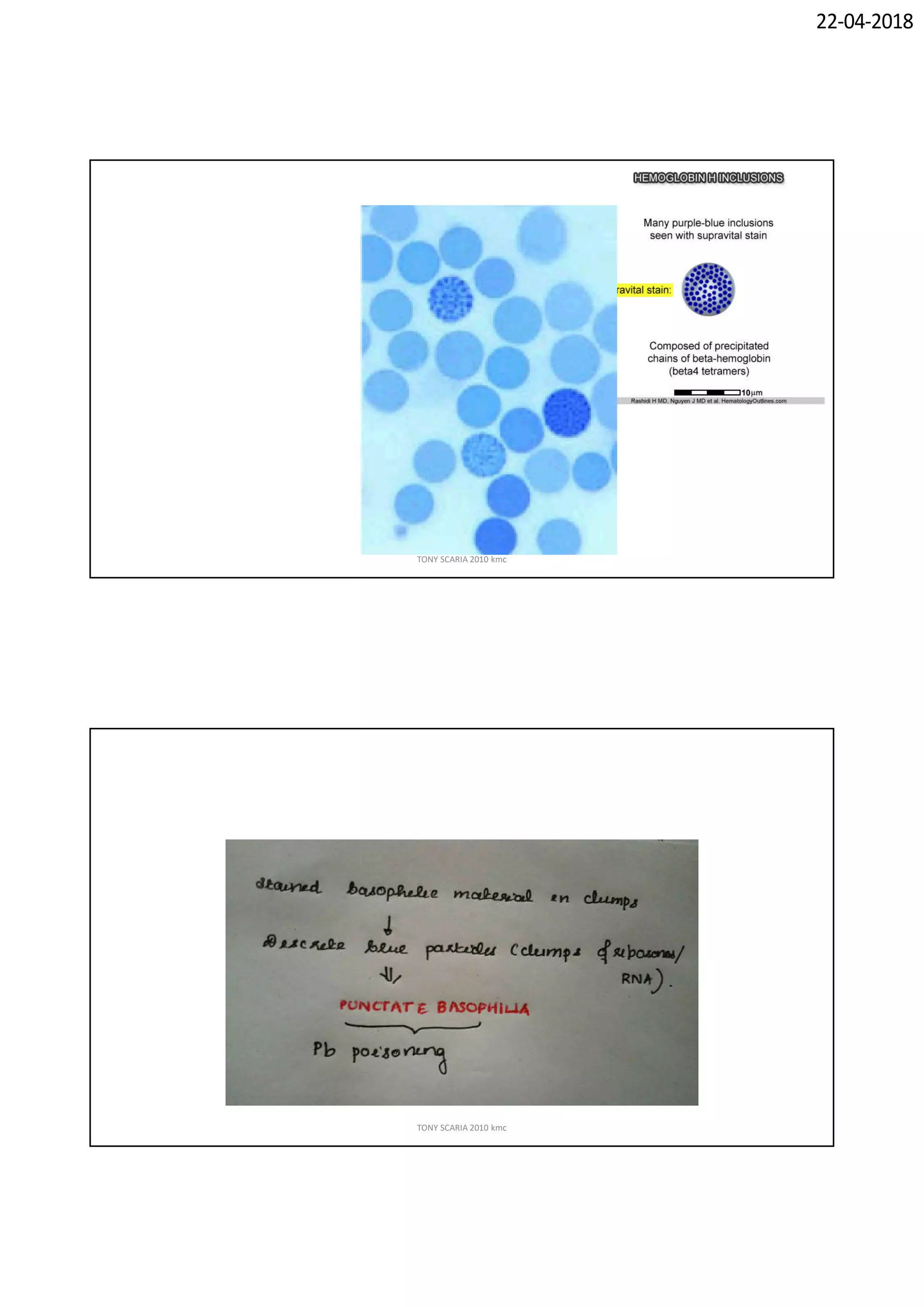 Hematology Notes.pdf Hematology revision notes pathology | PDF