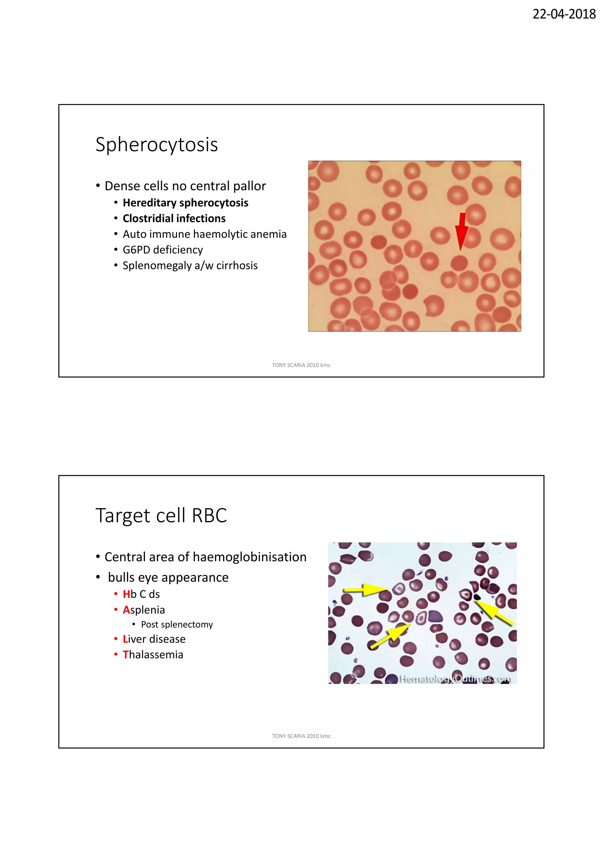 Hematology Notes.pdf Hematology revision notes pathology | PDF