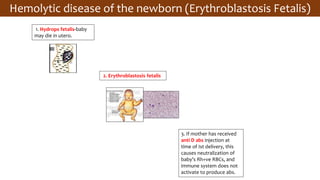 Hemolytic disease of the newborn (Erythroblastosis Fetalis)
1. Hydrops fetalis-baby
may die in utero.
3. If mother has received
anti D abs injection at
time of Ist delivery, this
causes neutralization of
baby’s Rh+ve RBCs, and
immune system does not
activate to produce abs.
2. Erythroblastosis fetalis
 