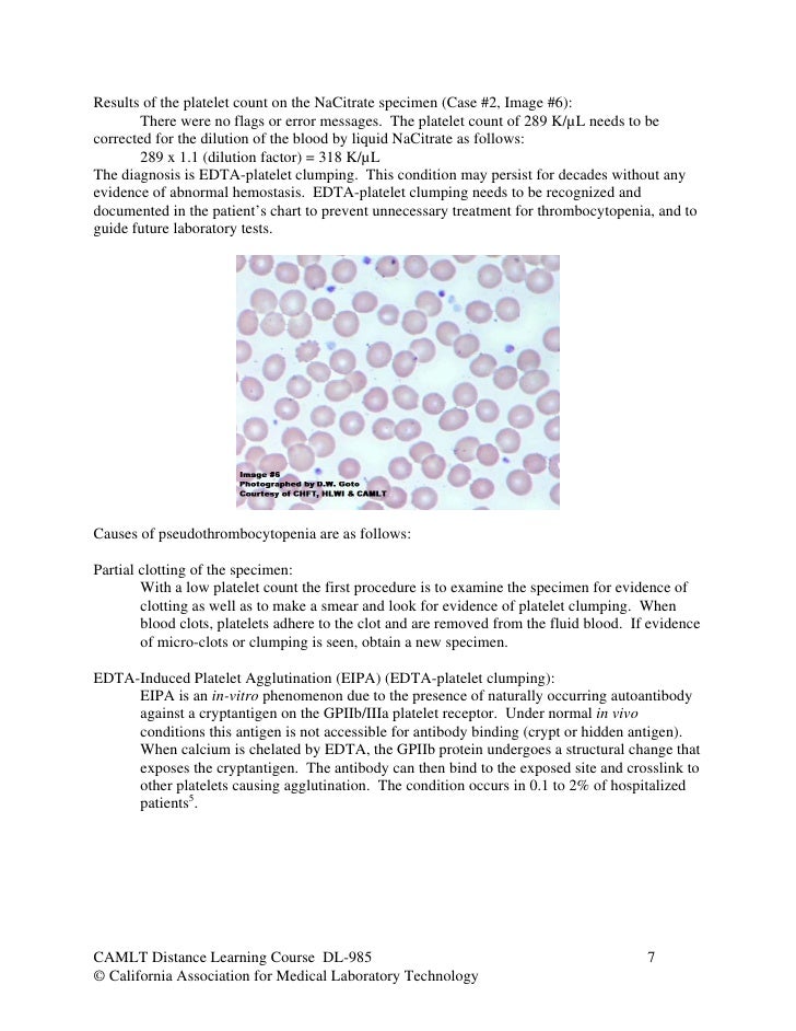 Hematology case studies platelets