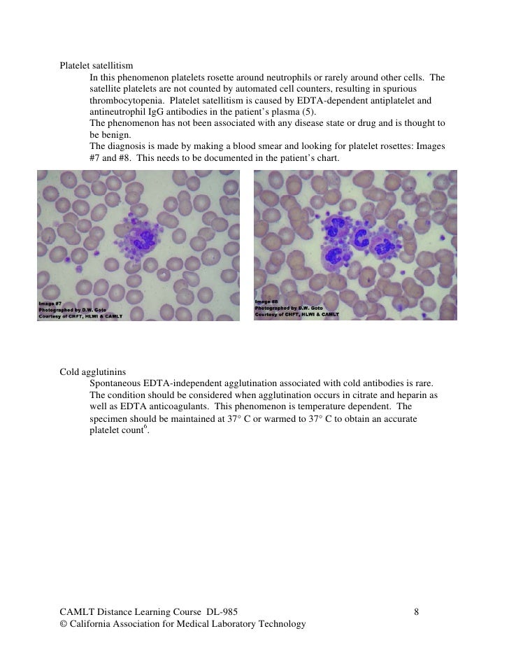 hematology case studies for students Case studies in clinical laboratory science this unique collection of 55 multidisciplinary case studies enables students to better hematology (10 case. hematology case studies for students Case studies in clinical laboratory science this unique collection of 55 multidisciplinary case studies enables students to better hematology (10 case.