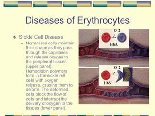 Diseases of Erythrocytes
Sickle Cell Disease
 Normal red cells maintain
their shape as they pass
through the capillaries
and release oxygen to
the peripheral tissues
(upper panel).
Hemoglobin polymers
form in the sickle rell
cells with oxygen
release, causing them to
deform. The deformed
cells block the flow of
cells and interrupt the
delivery of oxygen to the
tissues (lower panel).
 