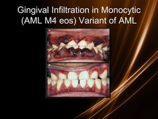 Gingival Infiltration in Monocytic
(AML M4 eos) Variant of AML
 