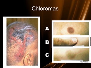 A
B
C
Chloromas
NEJM 1998
 