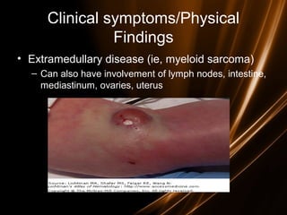 Clinical symptoms/Physical
Findings
• Extramedullary disease (ie, myeloid sarcoma)
– Can also have involvement of lymph nodes, intestine,
mediastinum, ovaries, uterus
 