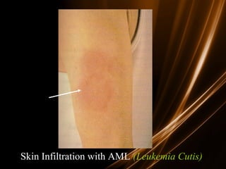Skin Infiltration with AML (Leukemia Cutis)
 
