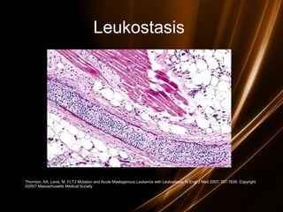Leukostasis
Thornton, KA, Levis, M. FLT3 Mutation and Acute Myelogenous Leukemia with Leukostasis. N Engl J Med 2007; 357:1639. Copyright
©2007 Massachusetts Medical Society
 