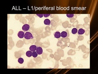 ALL – L1/periferal blood smear
 
