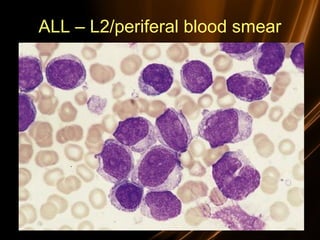ALL – L2/periferal blood smear
 