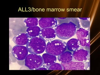 ALL3/bone marrow smear
 
