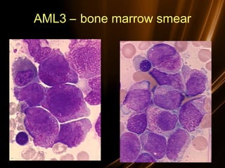 AML3 – bone marrow smear
 