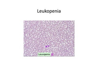 Leukopenia
 