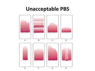 Unacceptable PBS
 