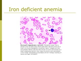 Iron deficient anemia
 