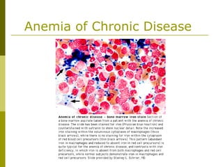 Anemia of Chronic Disease
 