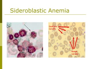 Sideroblastic Anemia
 