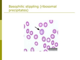 Basophilic stippling (ribosomal
precipitates)
 