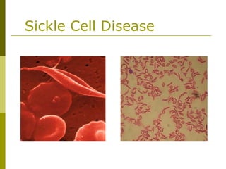 Sickle Cell Disease
 