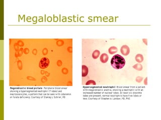 Megaloblastic smear
 