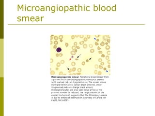 Microangiopathic blood
smear
 